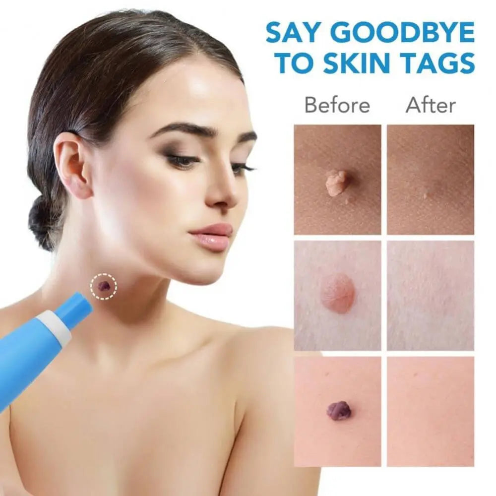 Auto Skin Tag Removal Kit - TARHUS