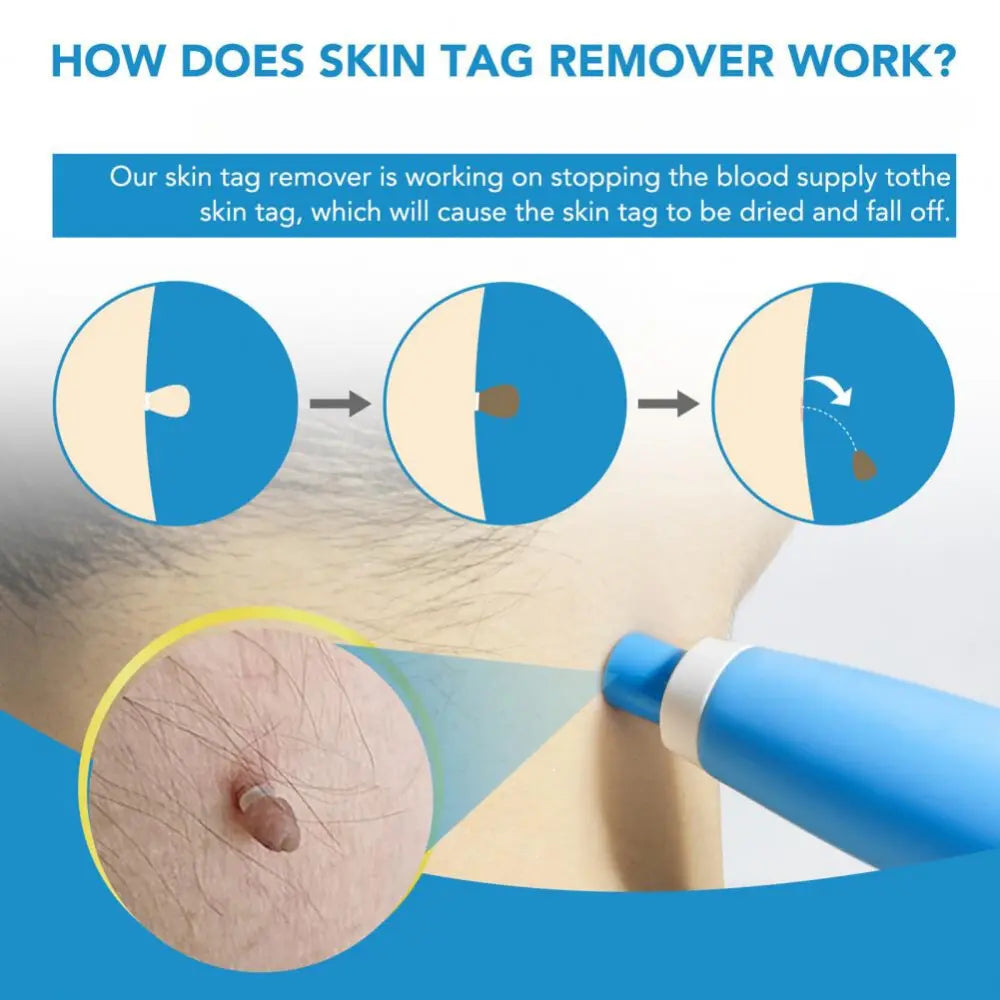 Auto Skin Tag Removal Kit - TARHUS