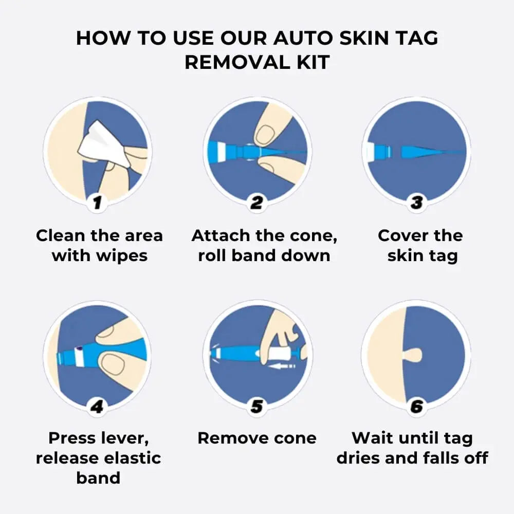Auto Skin Tag Removal Kit - TARHUS