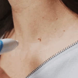 Auto Skin Tag Removal Kit - TARHUS